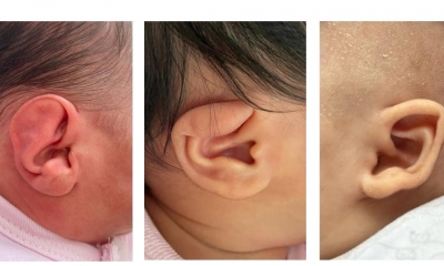 Yenidoğan bebeklerde ameliyatsız kulak şekillendirme